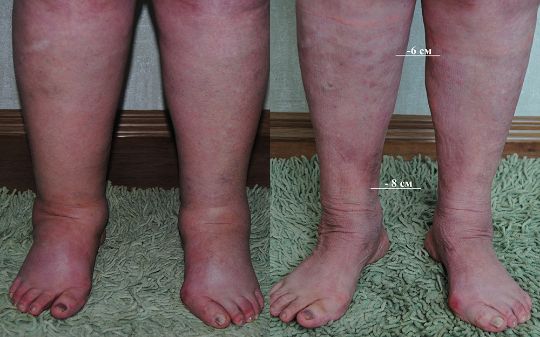 Лечение лимфостаза ног