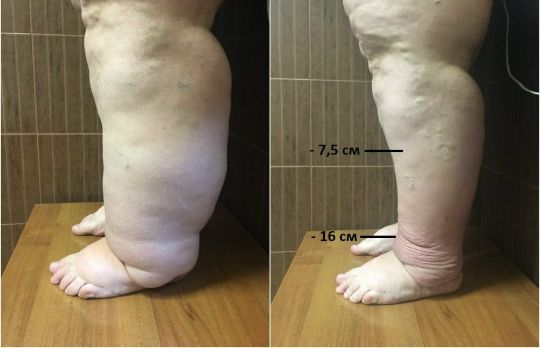 Лечение лимфостаза ног